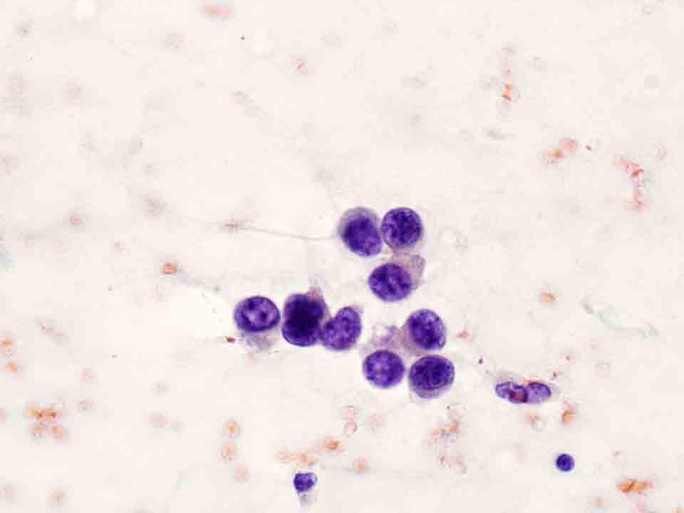 Bone, skull base, CT-guided FNA: Papanicolaou stain, 40x Presentation material is