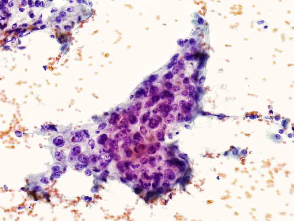 Bone, iliac wing, CT-guided FNA: Papanicolaou stain, 20x Presentation material is