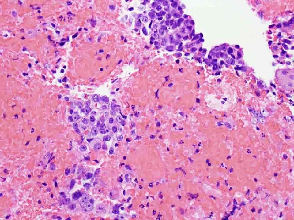 Lung, left, CT-guided FNA: Cell block, H & E