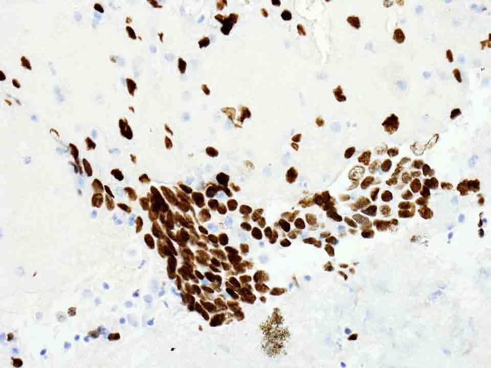 Lung, left, Cell block: TTF-1 Immunostain, 20x Presentation material is for