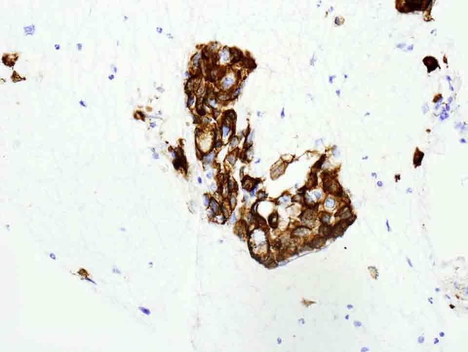 Lung, left, Cell block: CK 7 Immunostain, 20x Presentation material is for