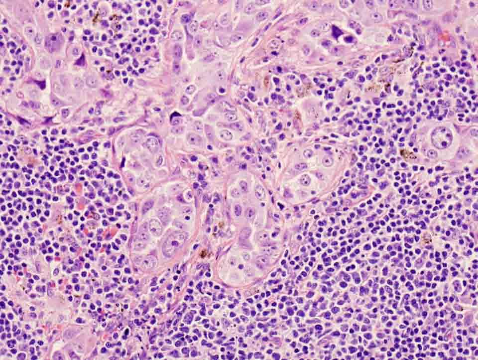 Lymph node, level 7, biopsy: H & E stain, 20x Presentation material is for