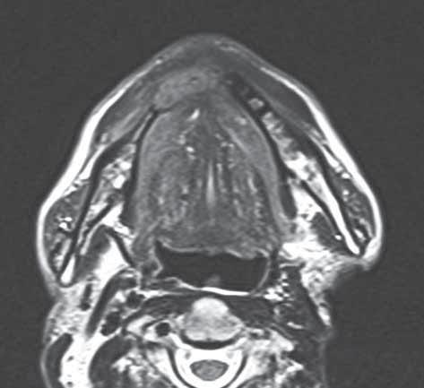 Fig. 2. Axial T2-weighted image shows destruction of the mandible, interrupted corticalis and intramedullary tumor extension (white arrows).
