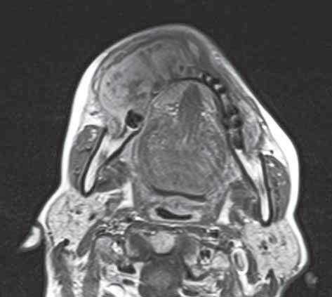 which appears grey because of its involvement by the tumor (white arrows). Fig. 3.