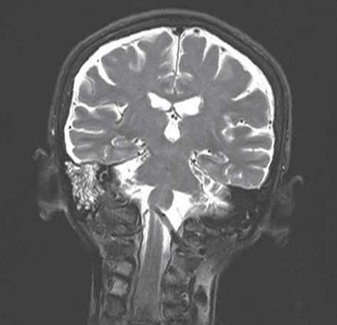 weighted image show perineural infiltration through inferior orbital fissure (white arrows). Pterygomaxillary space and pterygopalatine fossa are involved by the tumor (empty white arrow).