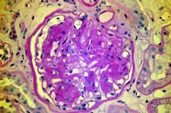 aspx Case A A) Normal Glomerulus A 6 yo patient with years of type 2 diabetes presents to your clinic as a