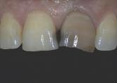 CASE 1 Figure 1. An intraoral 1:1 preoperative view of a darkened left central incisor tooth. Figure 2.
