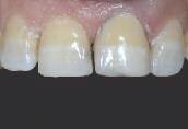 A full-smile postoperative view of the direct composite veneer fabricated with Uveneer on tooth No. 9. (Dentistry by Dr. Husam abu Diab, Qalqilya, Palestine.