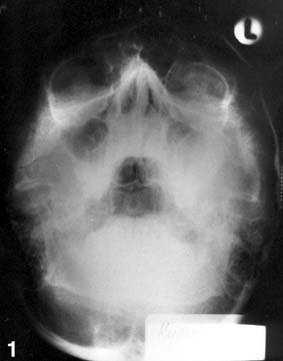 172 Stom Glas S, vol. 50, 2003. Slika 3. Poliostoti~na fibrozna displazija. Pregledni radiogram pacijenta sa slike 2 pokazuje lezije mandibule i maksile sa desne strane. Figure 3.