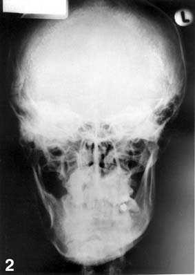 Radiogram pokazuje difuzni radiografski izgled lezije maksile sa leve strane. Figure 1. Fibrous dysplasia. Radiograph showing a diffuse "ground glass" radiographic appearance of the left maxilla.