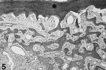Serbian Dental J, 2003, 50 173 Slika 5. Fibrozna displazija. Kost lezije je spojena sa korteksom (zvezdica). Figure 5. Fibrous dysplasia.