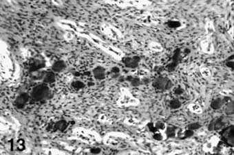 Trabeculae of woven bone surrounded by moderately cellular fibrous tissue. Slika 12. Osificiraju}i fibrom.