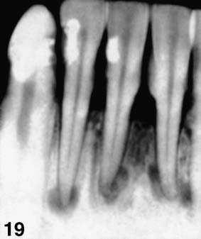 Serbian Dental J, 2003, 50 177 Terapija fokalne cemento-osealne displazije nije potrebna, osim dijagnosti~ke biopsije 11.