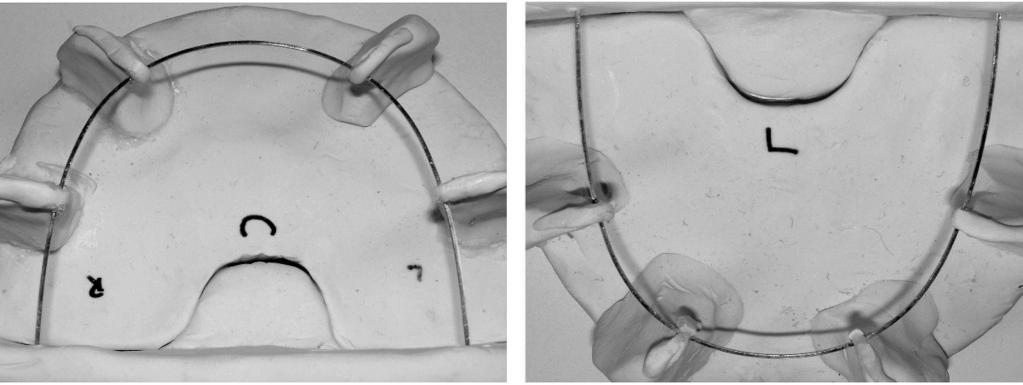 TRADITIONAL AND COMPUTER-AIDED BRACKET PLACEMENT METHODS 829 Figure 1. Mounted maxillary and mandibular archwires.