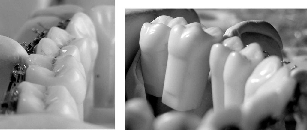 TRADITIONAL AND COMPUTER-AIDED BRACKET PLACEMENT METHODS 833 Figure 8. Comparison of mean point deductions of individual teeth within the buccolingual inclination component of the OGS.