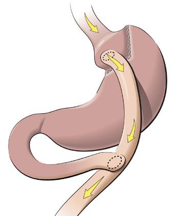 The most common bariatric procedures are Roux-en-Y gastric bypass and gastric sleeve surgery; gastric