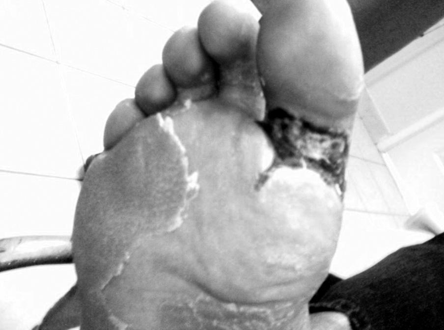 Józef Drzewoski et al. Infected diabetic foot can be successfully treated by primary care physicians Day 42 The whole wound without necrosis, fibrin deposits visible on the surface (Fig. 2).