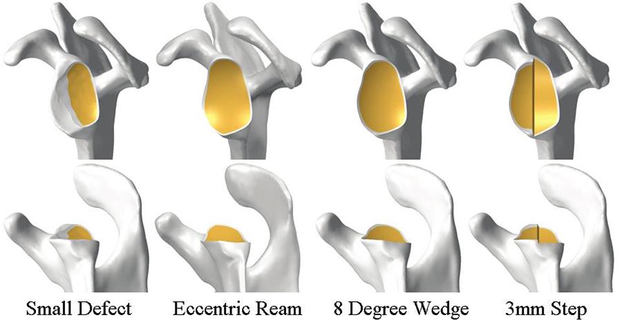 S7 from three different sizes of posterior glenoid defects using each glenoid design. Methods As described previously, 5-7 a computer model was developed to: 1.