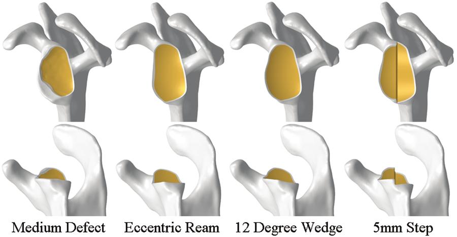 S8 Bulletin of the Hospital for Joint Diseases 2013;71(Suppl 2):S5-11 Figure 4 Lateral and inferior views of the glenoid bone remaining after correction of medium defect: medium defect (left),