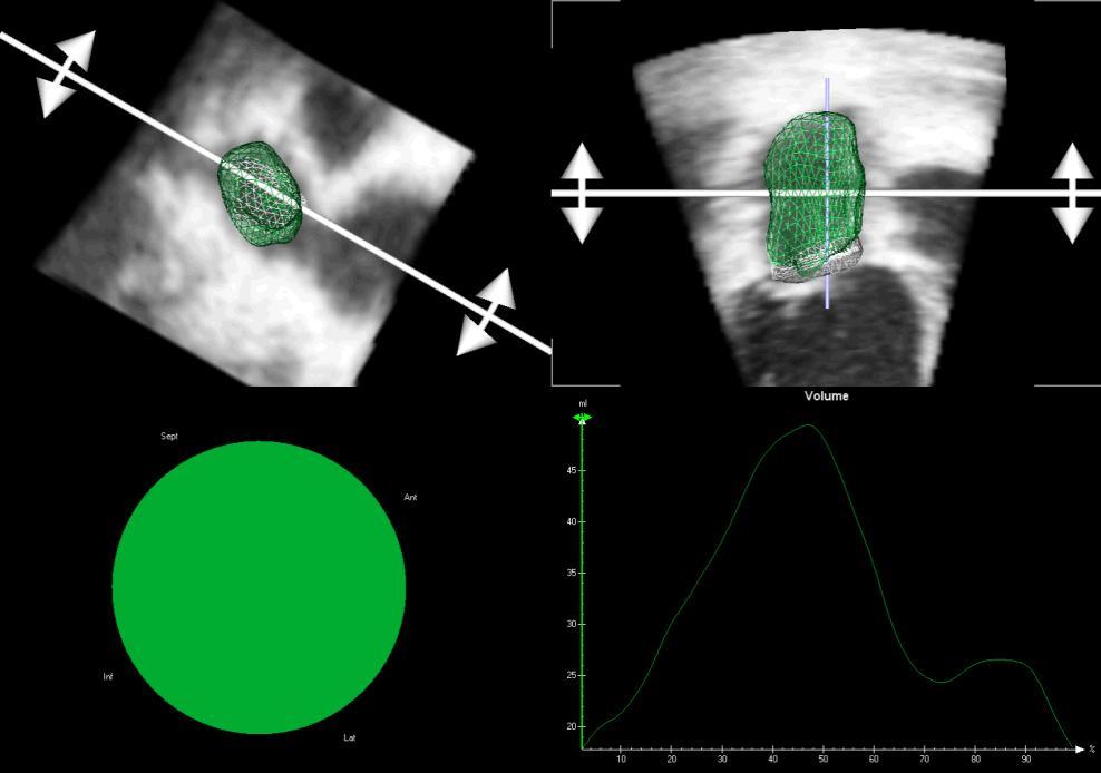LA size assessment by echocardiography The obtained 3DE