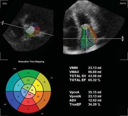 3D echocardiography Due to the availability of the 3D dataset at different phases of the cardiac cycle, the assessment