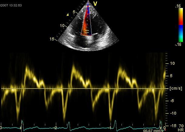 Myocardial velocities TDI allows the quantification of longitudinal myocardial velocities, providing a relatively load independent measure of both LV systolic