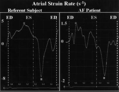 LA strain parameters Atrial function assessed by