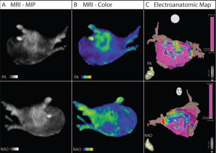 LA structure assessment by MRI The MRI with late gadolinium enhancement allows tissue characterization and fibrosis or scar imaging This study presents an imaging