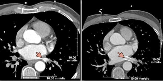 LA assessment by CT Multiplanar reconstruction images of a patient, 3 months after atrial fibrillation ablation,