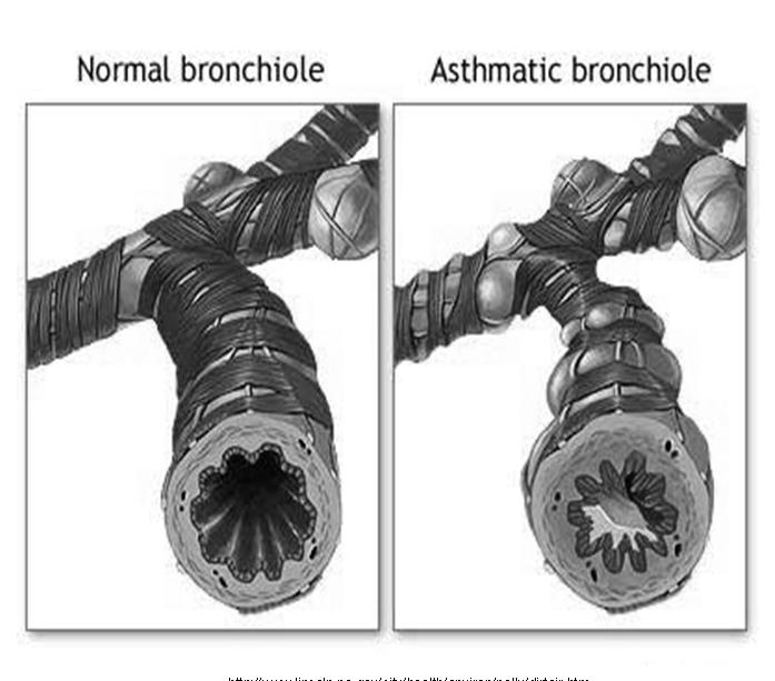 Asthma Increased responsiveness of the trachea and bronchi to stimuli Narrowing of airways http://www.lincoln.ne.gov/city/health/environ/pollu/dirtair.