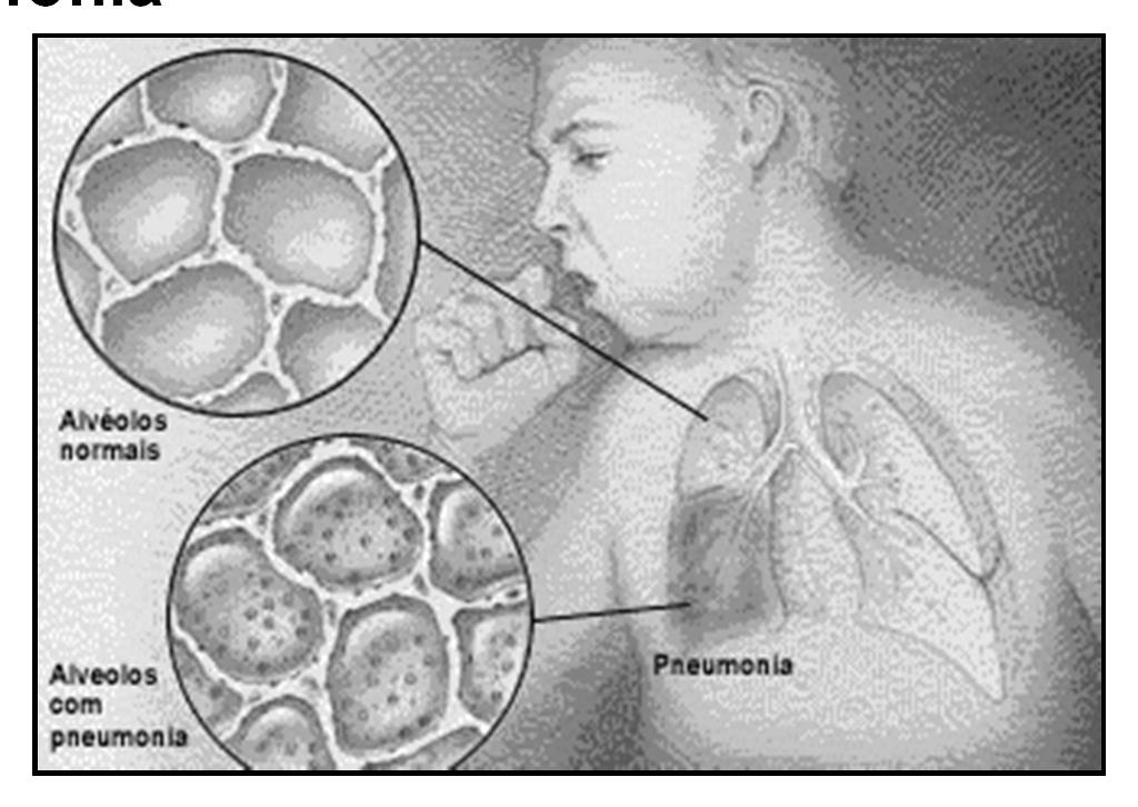 Pneumonia Pneumonia: Signs/Symptoms