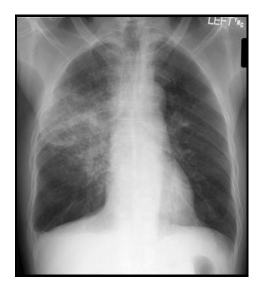 Lung consolidation on physical exam