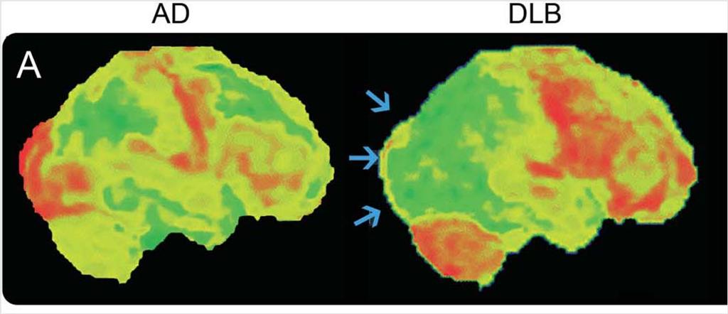 COGNITIVE PATTERNS IN DLB VISUOSPATIAL FUNCTIONS FDG-PET Disproportionately severe visuospatial and visuo-constructive deficit in patients with DLB compared to those with AD The spatial and