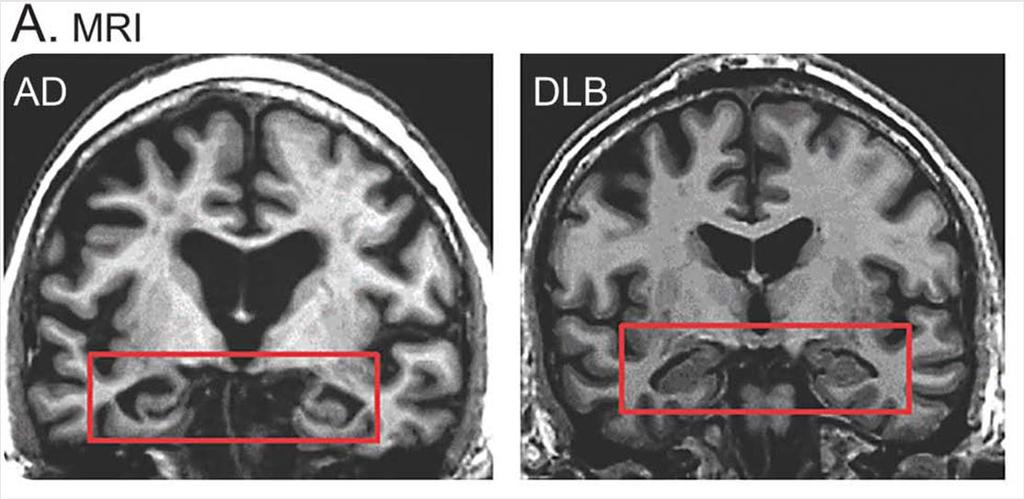 COGNITIVE PATTERNS IN DLB MEMORY AND LANGUAGE Memory and object naming tend to be less affected in DLB, although some patients difficulties may be secondary to speed or retrieval task demands.