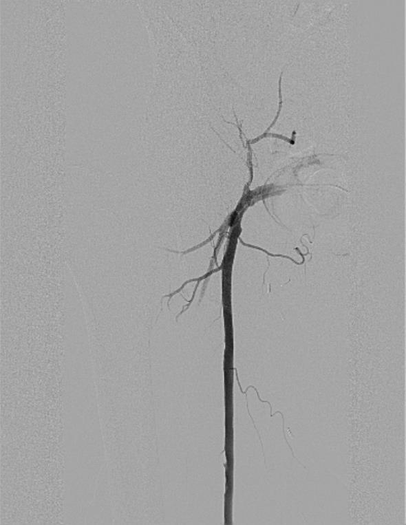 Initial Angiogram Accessed the Fem-Fem Severe SFA Stenosis Seen