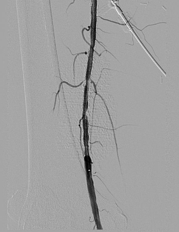 Initial Angiogram Accessed the Fem-Fem Severe SFA Stenosis Seen