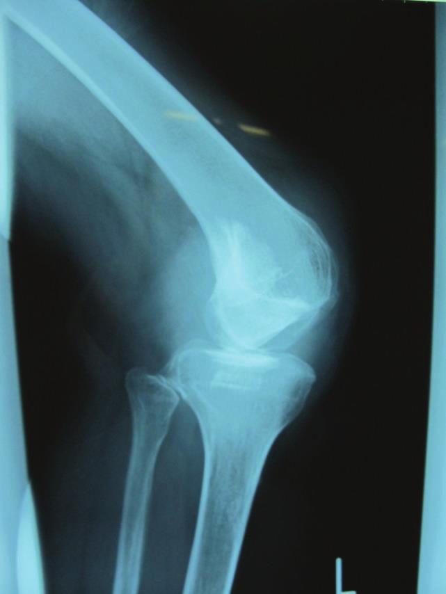 Roentgenograms and computed tomography (CT) showed patellar dislocation and severe osteoarthritis of the bilateral knees with complete loss of the lateral compartment joint space (Figures 1 3).