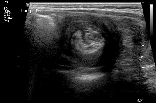 Intussusception and Ultrasound Identification of intussusception High accuracy, nearly 100% in experienced hands Sensitivity of