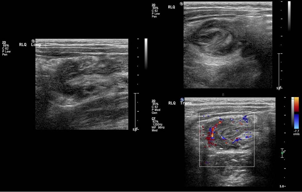 Ileocolic Intussusception Intussusception and Ultrasound: Assessment of Reducibility Sonographic findings of bowel necrosis and other potential limitations in reduction: Little blood
