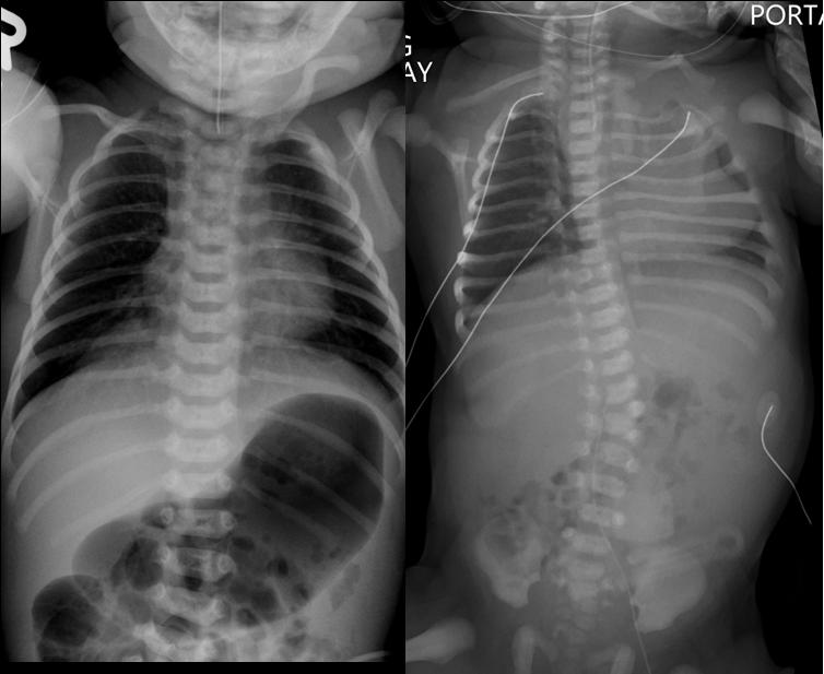 Radiographic Assessment Bowel gas? Vertebral anomaly? Cardiac silhouette? What is VACTERL/VATER?