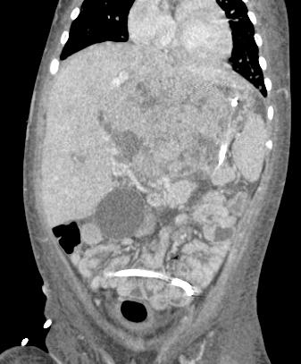 Hepatoblastoma A malignant tumor, usually presents by age 5 No definite association with chronic liver disease