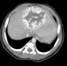 Congenital hemangioma A large benign hemangioma May cause high-output cardiac failure due to arteriovenous shunting May cause respiratory distress due to large size Suspect