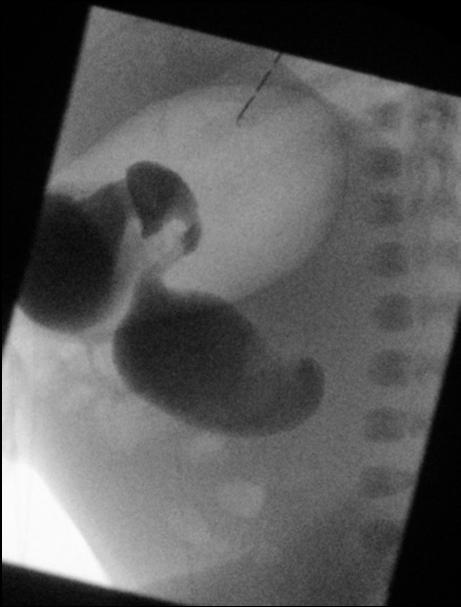 Small bowel is placed in right abdomen. 5. Large bowel is placed in left abdomen. 6.