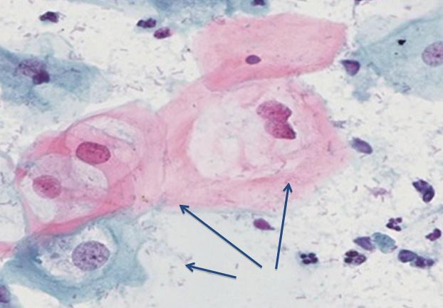 cytology to screen, using colposcopy to ssess nd direct iopsy, nd using histology to confirm the dignosis (Fig. 3.2).
