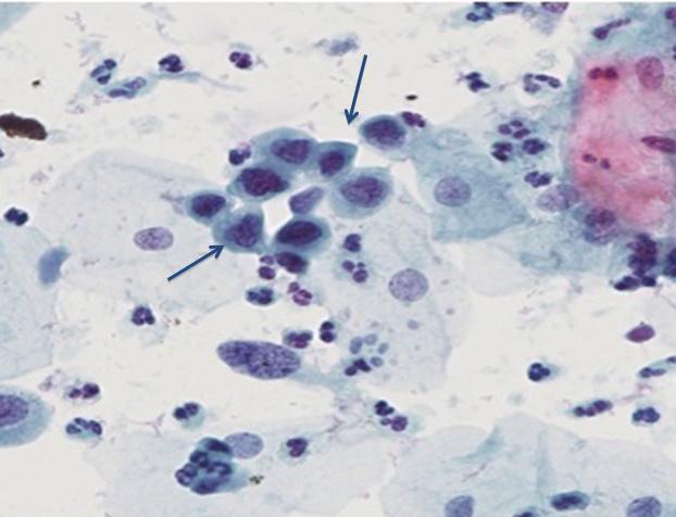 koilocytosis in the superficil lyers nd even prt of the intermedite lyer, ut the undifferentited cells will e limited to the lower third of the epithelium (Fig. 3.5)