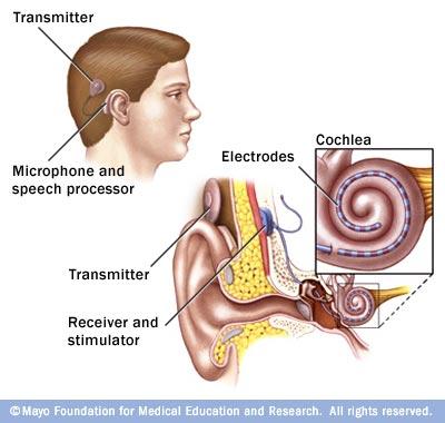 COCHLEAR IMPLANTS AUDITION - CORTEX There are