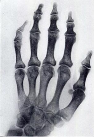 The epiphyses of the proximal phalanges are narrowed and dense.