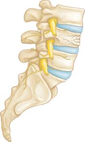 There are different types of spinal fractures. Doctors classify fractures of the thoracic and lumbar spine based upon pattern of injury and whether there is a spinal cord injury.