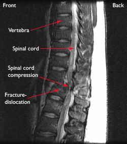 A magnetic resonance imaging (MRI) scan of a fracture dislocation in the thoracic spine. Note the disruption of the spinal cord.