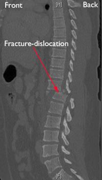 A CT scan taken from the side of a fracture dislocation in the thoracic spine. An emergency room physician will conduct a thorough evaluation, beginning with a head to toe examination of the patient.